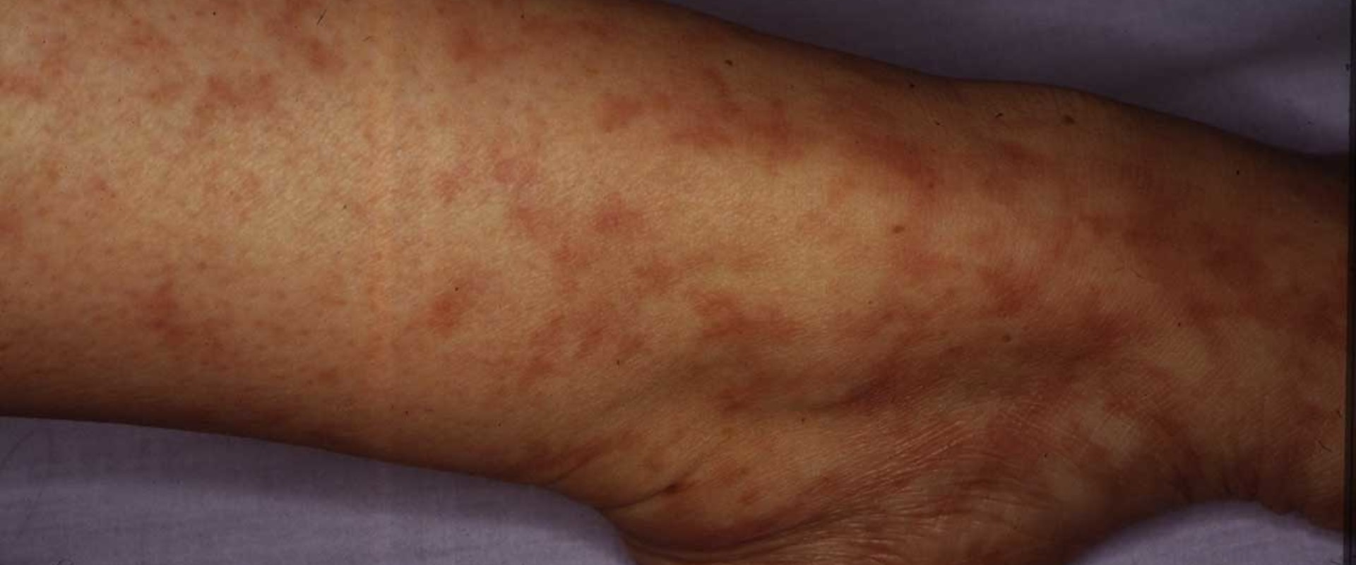 Can Cancer Radiation Cause a Fever?