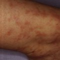 Can Cancer Radiation Cause a Fever?