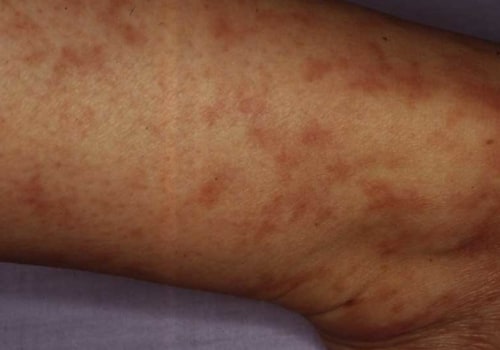 Can Cancer Radiation Cause a Fever?